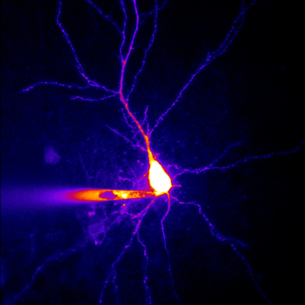 Forscher der Universität Bonn entdecken einen neuen Mechanismus, der zur Epilepsie führt + + + mehr: