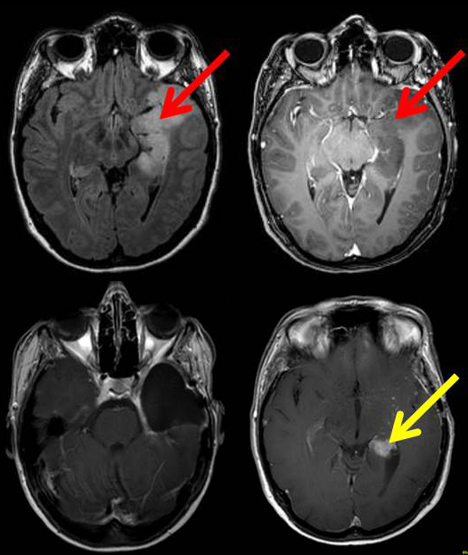 Bilder des Gehirns einer Patientin mit einem Gliom 