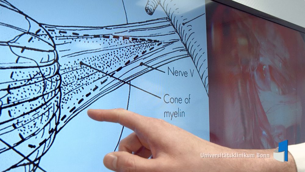 Hand zeigt auf Grafik zu Trigeminusneuralgie