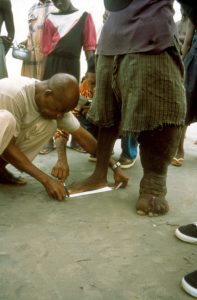 Arzt vermisst Fuß von Patienten mit Elephantiasis