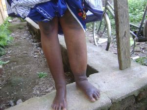 Beinpaar mit Elephantiasis am linken Bein