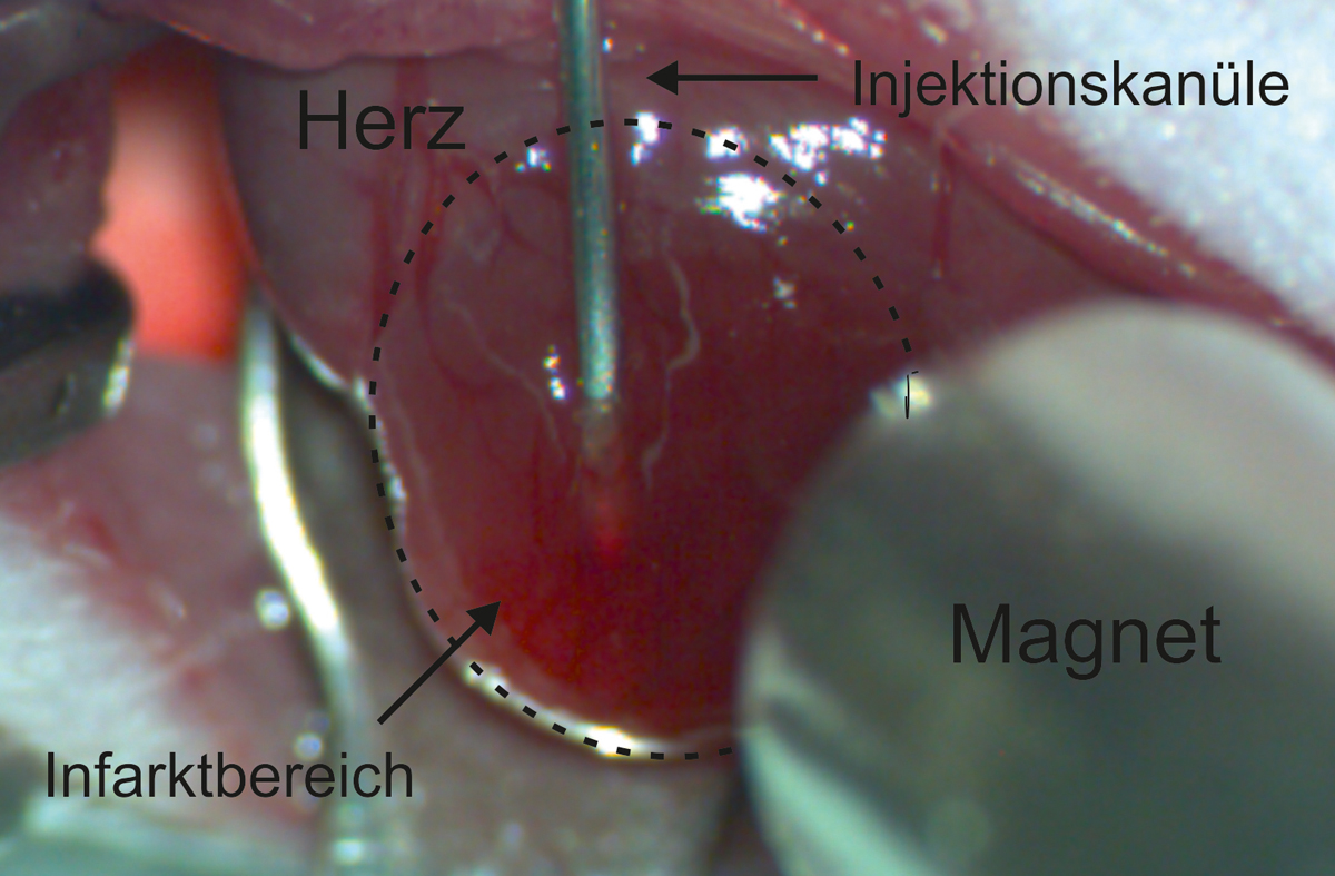 Über eine in das Infarktareal eingebrachte Kanüle werden die mit magnetischen Nanopartikeln beladenen Zellen in das geschädigte Herzmuskelgewebe der Maus gespritzt