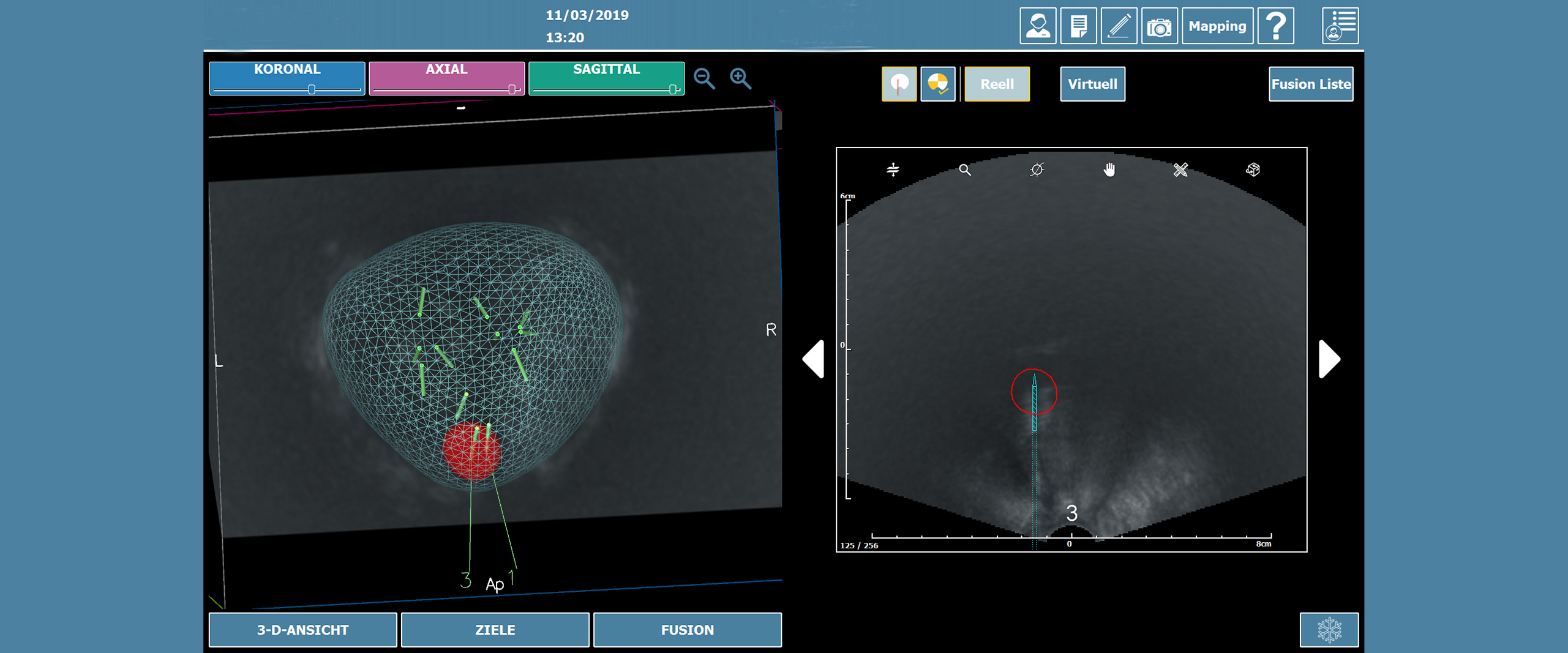 MRT gestuetzte Prostatafusionsbiopsie