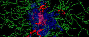 Entzündungsproteine (sogenannte ASC Specks, rot) im Kern einer Ansammlung von Amyloid-Beta-Peptiden (blau). Des Weiteren sind Immunzellen (grün) dargestellt.
