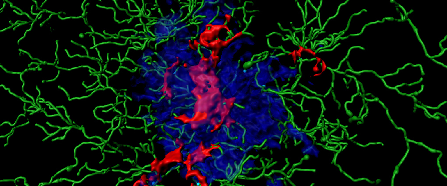 Entzündungsproteine (sogenannte ASC Specks, rot) im Kern einer Ansammlung von Amyloid-Beta-Peptiden (blau). Des Weiteren sind Immunzellen (grün) dargestellt.