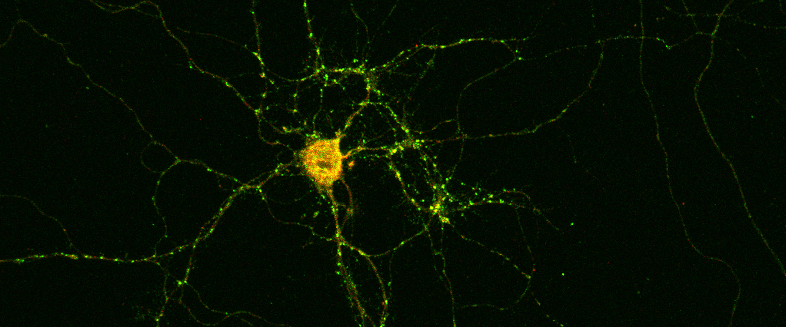 Nervenzelle eines Patienten mit ihren Fortsätzen: Die hellen Punkte markieren die Synapsen, über die sie mit anderen Nervenzellen kommuniziert. Die Anti-Drebrin-Autoantikörper sind gelb gefärbt.