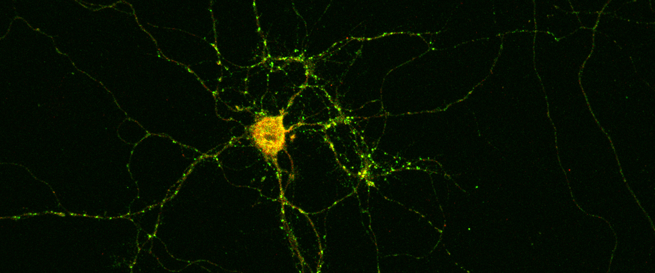 Antikörper im Gehirn lösen Epilepsie aus