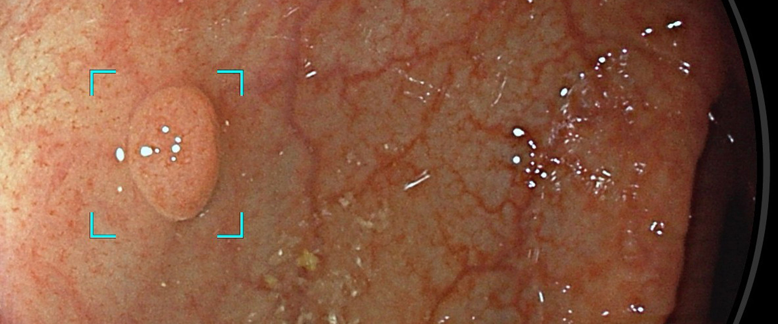 Mit Hilfe künstlicher Intelligenz wurde bei einem Betroffenen mit Lynch-Syndrom ein Darmpolyp gefunden