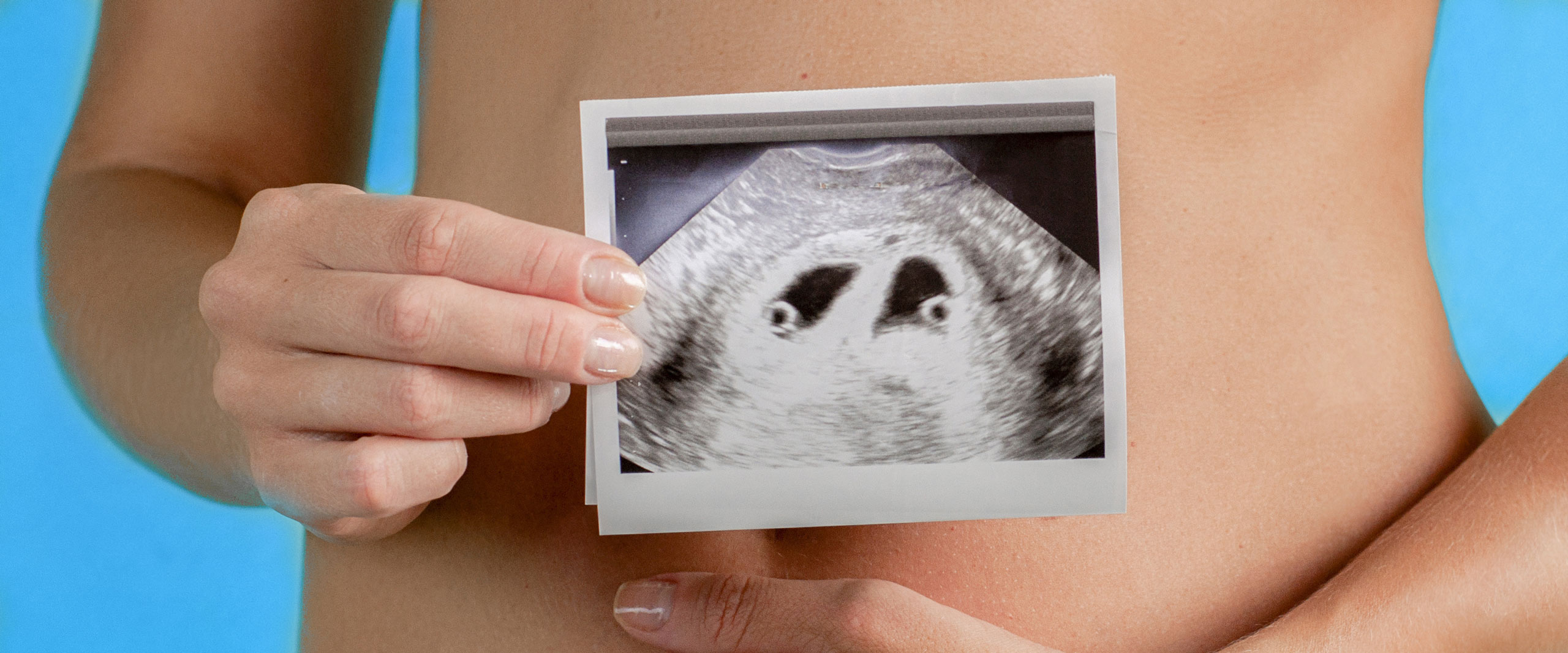 Ultraschallbild einer Zwillingsschwangerschaft
