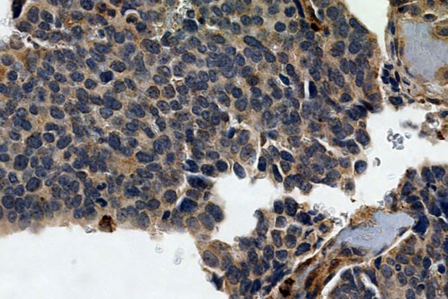 Metastasierte Prostatakarzinomzellen