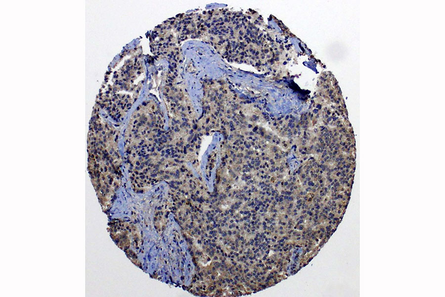 Metastasierte Prostatakarzinomzellen