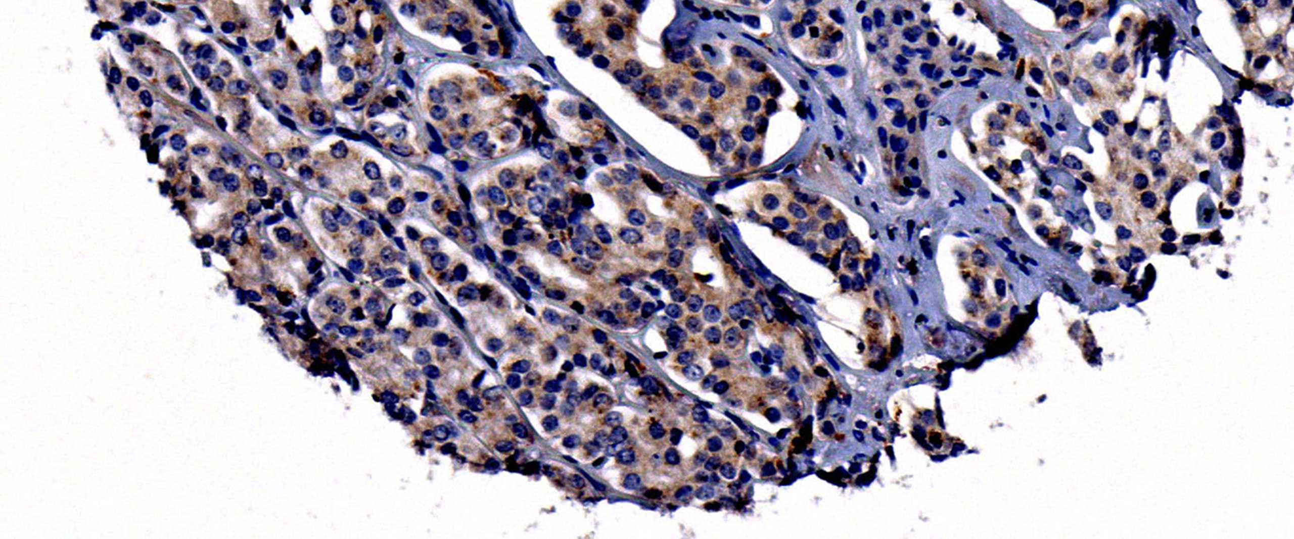 Prostatakarzinomzellen mit Nachweis des Neuropilin-2-Proteins in braun