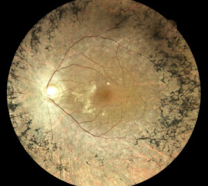 Retinitis Pigmentosa