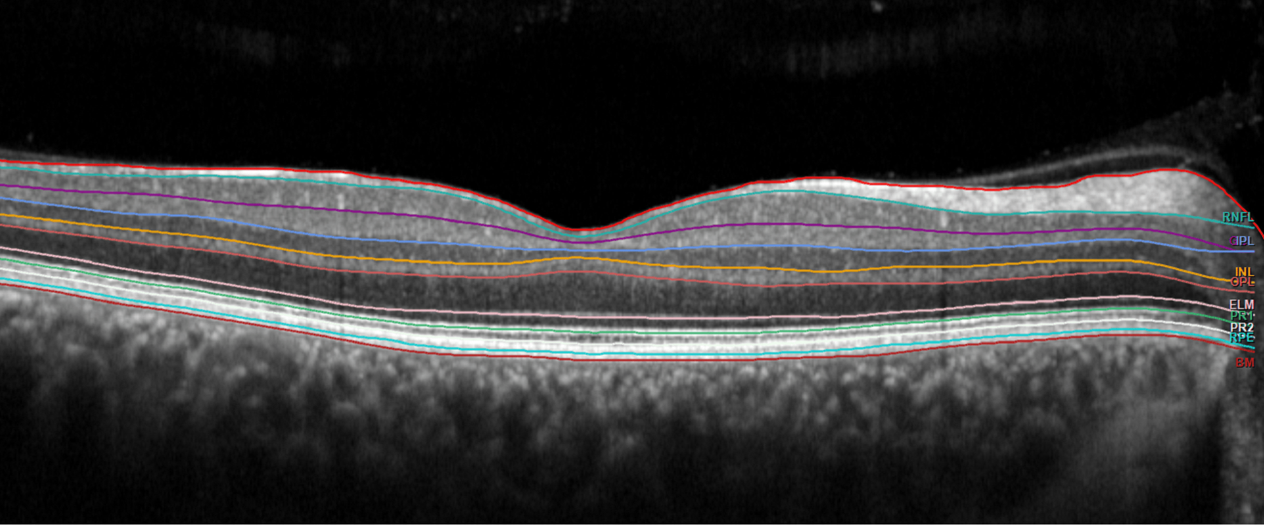 Die Netzhaut als möglicher Biomarker für reduzierte Hirnsubstanz