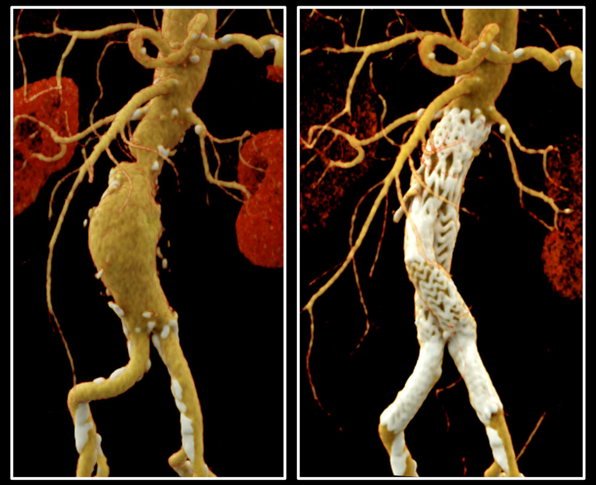 Bauchaortenaneurysma