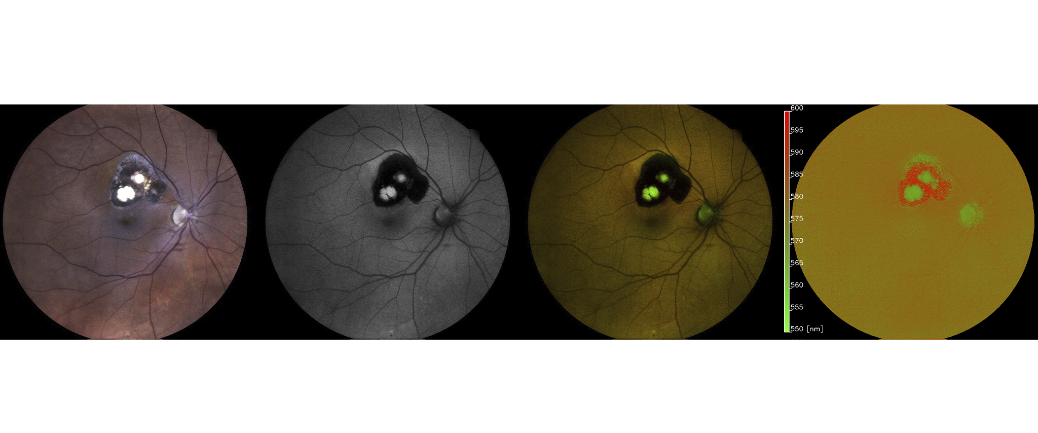 Neue Diagnosemöglichkeit für seltene Augenerkrankung