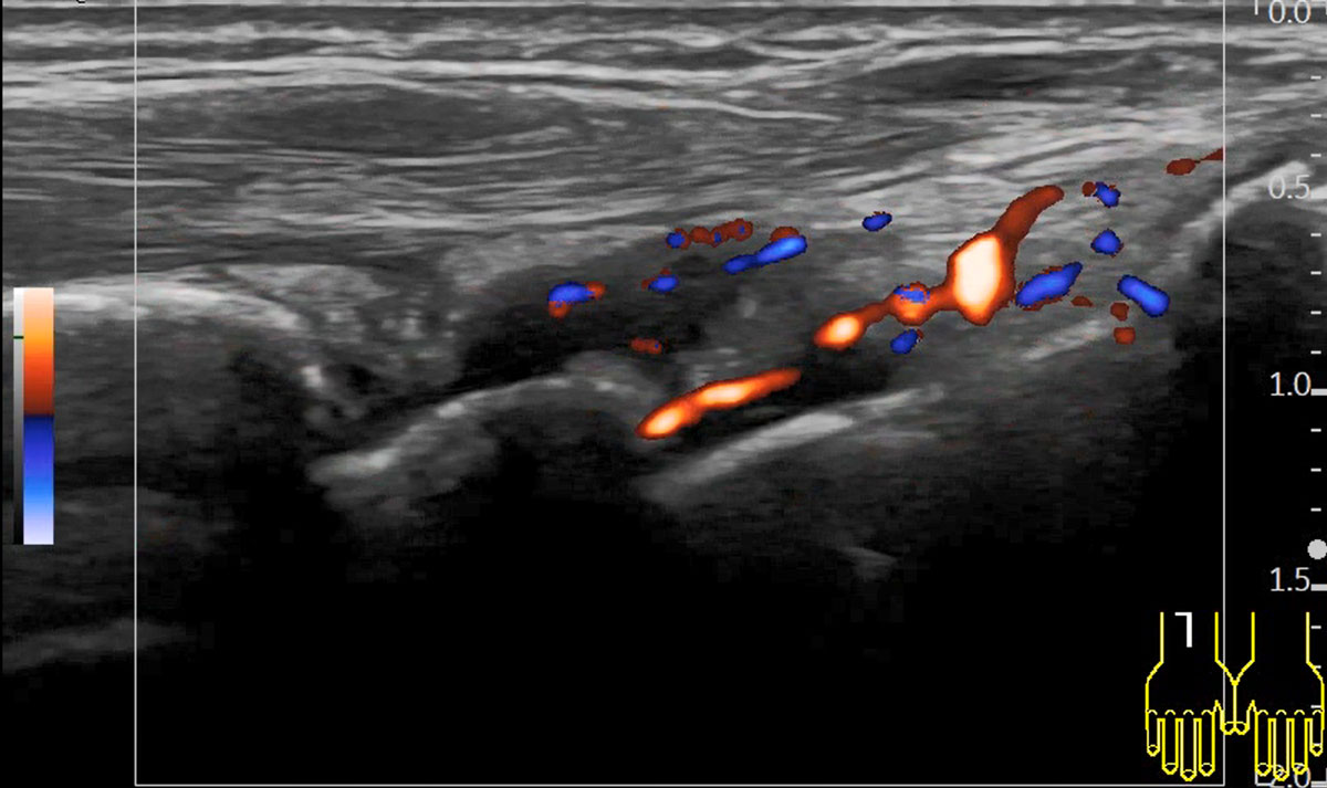 Sonographie in der Diagnose: Hier zeigt sich im Power-Doppler eine Handgelenksarthritis mit Hyperfusion. Im Anschluss an das Patientenkolloquium wird den Besuchenden eine Gelenksonographie zur Früherkennung entzündlicher Veränderungen in den Gelenken angeboten.