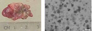 Links: Tumorgewebe von Patienten. Rechts: Aus dem Tumorgewebe generierte Tumor-Organoide.