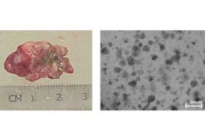 Links: Tumorgewebe von Patienten. Rechts: Aus dem Tumorgewebe generierte Tumor-Organoide.