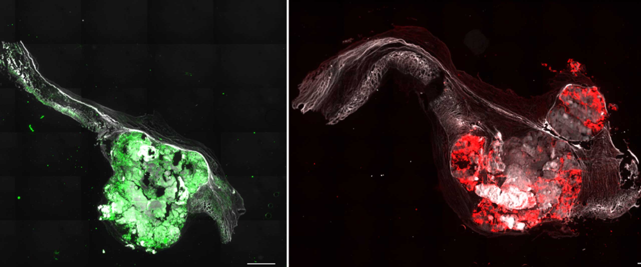 Immunfluoreszenz-Färbung von Schnitten menschlicher Aortenklappen (links Aortenklappenstenose mit 3 Segeln, rechts Aortenklappenstenose mit 2 Segeln). Die Farben zeigen verschiedene markierte Proteine, die für die Krankheitsentstehung von Bedeutung sind.