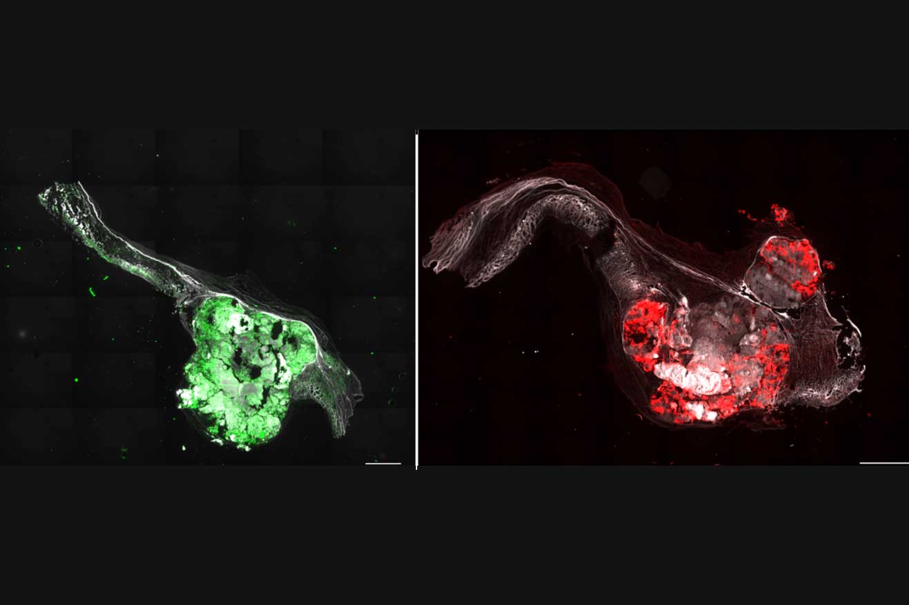 Immunfluoreszenz-Färbung von Schnitten menschlicher Aortenklappen (links Aortenklappenstenose mit 3 Segeln, rechts Aortenklappenstenose mit 2 Segeln). Die Farben zeigen verschiedene markierte Proteine, die für die Krankheitsentstehung von Bedeutung sind.