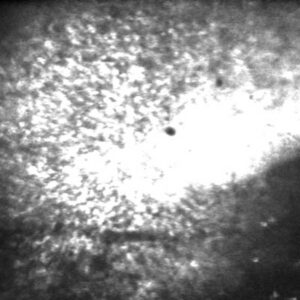 Aufnahme langsamer Depolariationswellen, sogenannte Spreading Depolarization (SD), nach einem epileptischen Anfall.