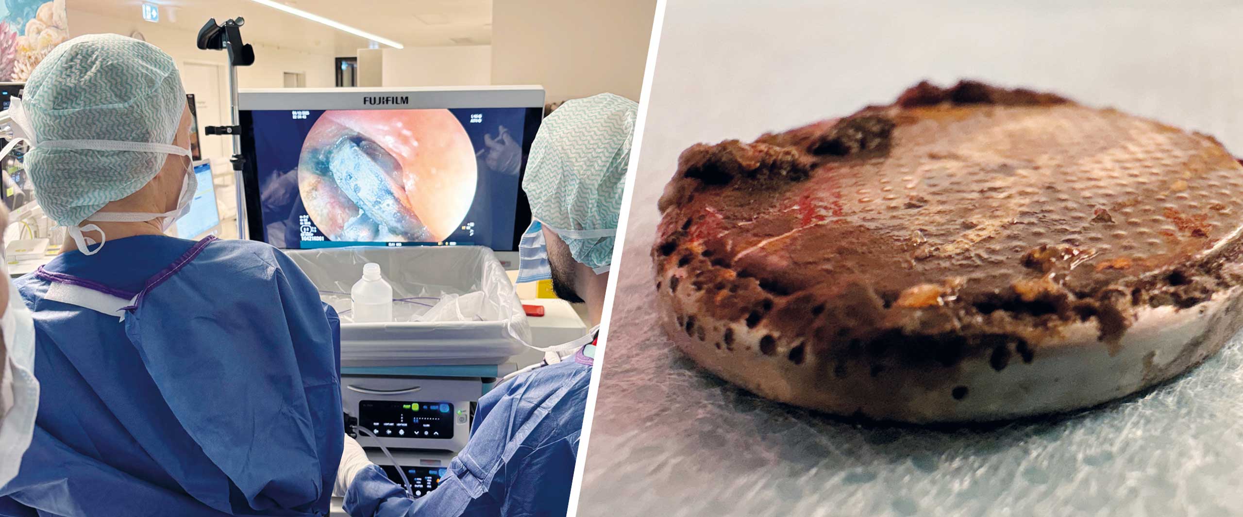 Endoskopische Entfernung einer Knopfzelle aus der Speiseröhre eines Kindes im Eltern-Kind-Zentrum (ELKI) des UKB / (rechts) Die entfernte Knopfzelle.