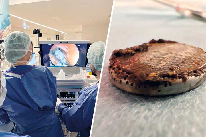 Endoskopische Entfernung einer Knopfzelle aus der Speiseröhre eines Kindes im Eltern-Kind-Zentrum (ELKI) des UKB / (rechts) Die entfernte Knopfzelle.