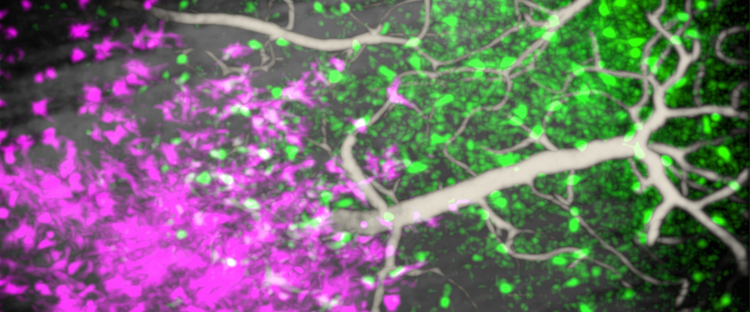 Studie zeigt dynamische Wechselwirkungen zwischen Hirntumoren und Immunzellen