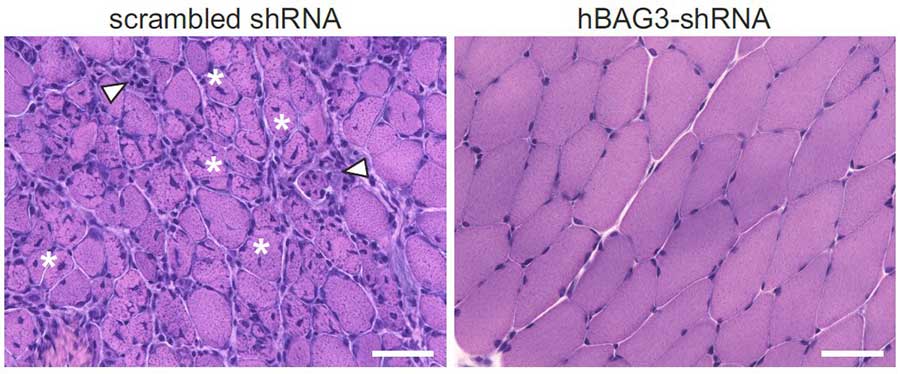 Nach einer experimentellen Therapie, die die Menge des krankmachenden BAG3-Proteins vermindert, zeigen sich deutlich weniger Schäden (Sternchen) und Entzündungszellen (weiße Dreiecke) in der Skelettmuskulatur der behandelten Mäuse (rechts, hBAG3 shRNA) im Vergleich zu den Kontrollen (links, scrambled shRNA). Hämatoxylin-Eosin-Färbung von histologischen Schnitten von Skelettmuskelbiopsien.